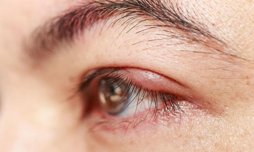 Κριθαράκι στο μάτι: Με ποιες 4 φυσικές θεραπείεςτο αντιμετωπίζουμε